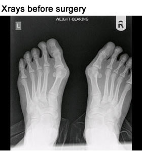 Patricia feet X-ray post operation at Nuffield Health Leicester Hospital