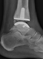 Ankle Arthroscopy