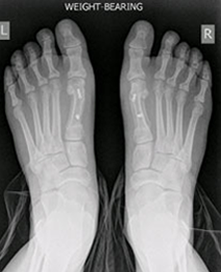 Ankle Arthroscopy